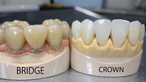 Difference Between a Bridge and a Crown in Dentistry